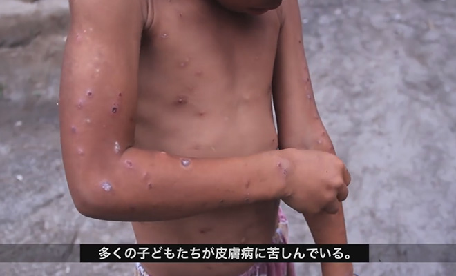 多くの子どもたちが皮膚病に苦しんでいる